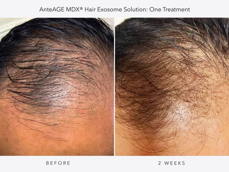 Hair Restoration Special