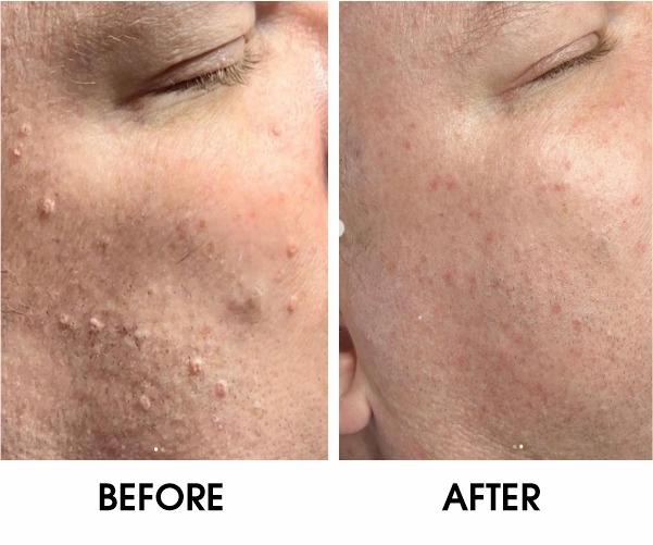 Sebaceous Hyperplasia